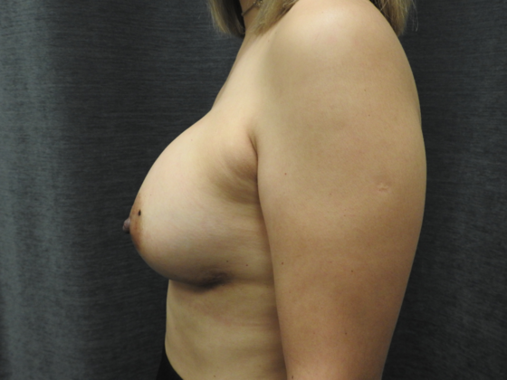 Breast Augmentation: Case 12 - After