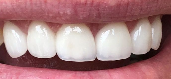 Porcelain Dental Crowns Case 4 - After