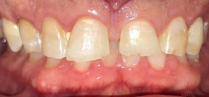 Porcelain Dental Crowns Case 4 - Before