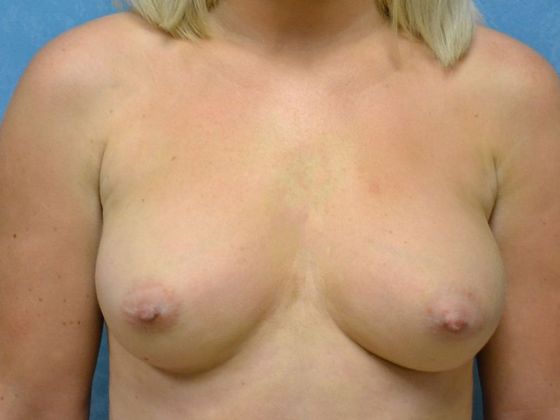 Breast Augmentation BA1342 - Toledo, OH - Before