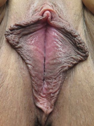 Labiaplasty: Case 13 - Before