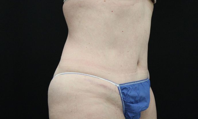 Tummy Tuck: Case 28 - After