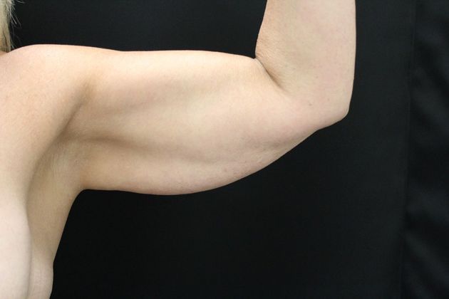 Arm Lift: Case 11 - Before