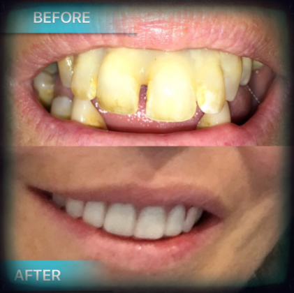 Cosmetic Dentistry Case 3: Smile Makeover