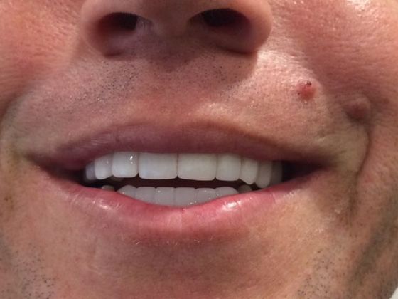 Cosmetic Dentistry: Case 4: Crowns and Veneers - After