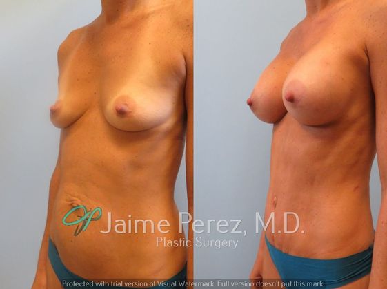 Breast Augmentation: 34-year-old female: Breast Augmentation with 350cc to 400cc Silicone Implants - Before & After