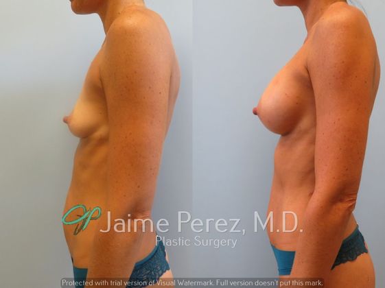 Breast Augmentation: 34-year-old female: Breast Augmentation with 350cc to 400cc Silicone Implants - Before & After