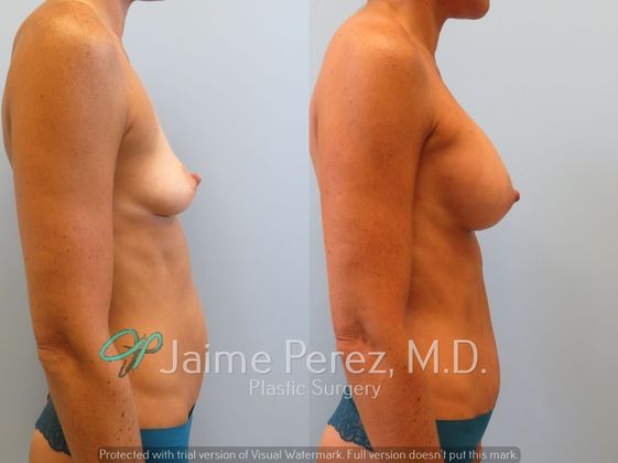 Breast Augmentation: 34-year-old female: Breast Augmentation with 350cc to 400cc Silicone Implants - Before & After