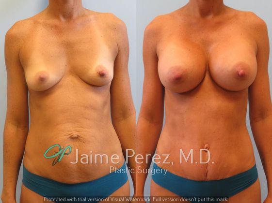 Breast Augmentation: 34-year-old female: Breast Augmentation with 350cc to 400cc Silicone Implants - Before & After