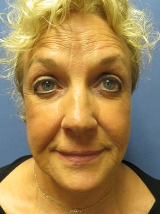 Facelift / RestoreLift Case 2 - Before