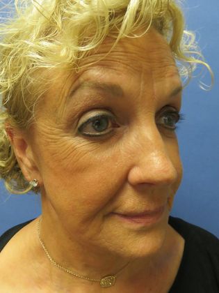 Facelift / RestoreLift: Case 2 - After