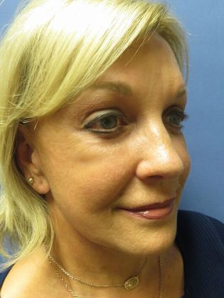 Facelift / RestoreLift: Case 2 - Before