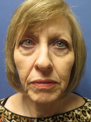 Facelift / RestoreLift Case 7 - Before