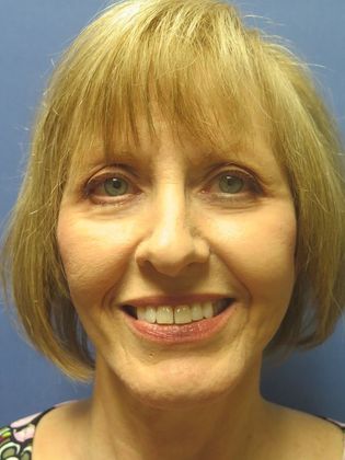 Facelift / RestoreLift Case 7 - After