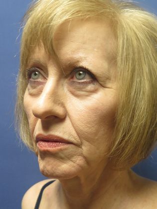 Facelift / RestoreLift: Case 7 - Before
