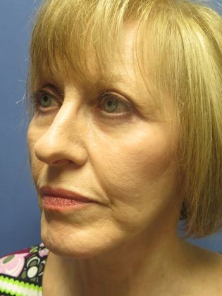 Facelift / RestoreLift: Case 7 - After