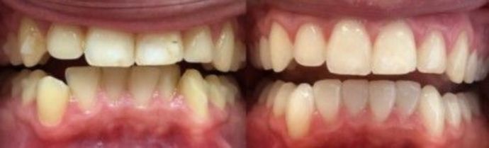 Porcelain Veneers: Case 3 - Before