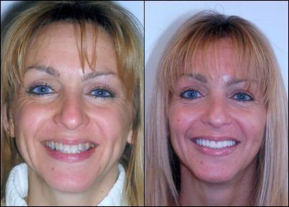 Porcelain Veneers: Case 8 - Before