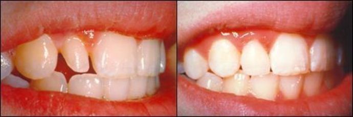 Porcelain Veneers: Case 9 - Before