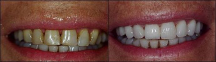 Porcelain Veneers: Case 10 - Before