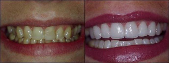 Porcelain Veneers: Case 11 - Before