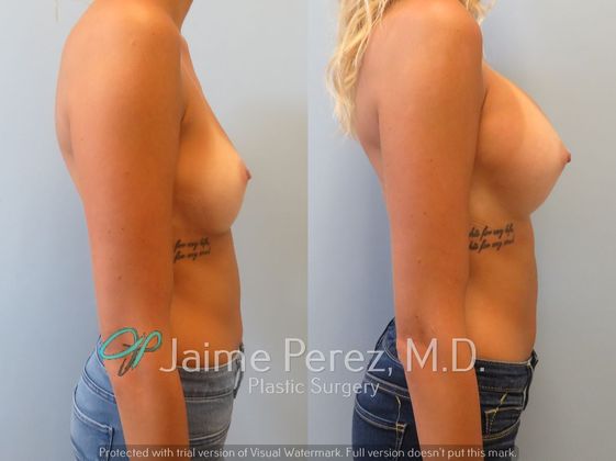 Breast Augmentation: 24-year-old: Breast Augmentation with 475cc Smooth, Round Silicone Implants - Before & After