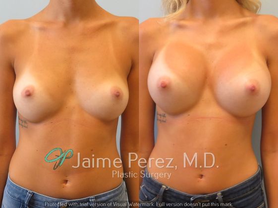 Breast Augmentation: 24-year-old: Breast Augmentation with 475cc Smooth, Round Silicone Implants - Before & After