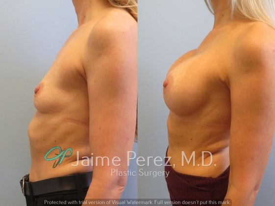 Before & After