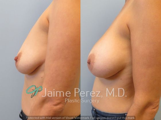 Breast Augmentation: 39-year-old Female: Breast Augmentation using 425cc Silicone Implants - Before & After