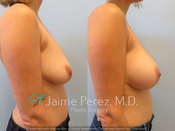 Breast Augmentation: 39-year-old Female: Breast Augmentation using 425cc Silicone Implants - Before & After