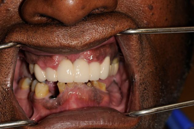 Full Mouth Reconstruction: Case 1 - Before