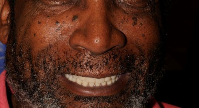 Full Mouth Reconstruction Case 1 - After