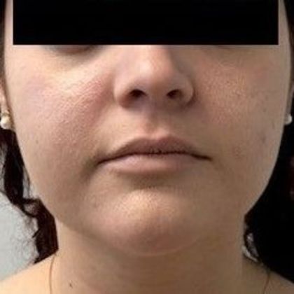 Kybella injection Case 1 Kybella injection, Greenwich - After