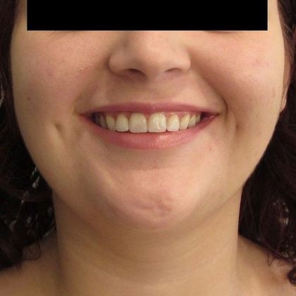 Kybella injection Case 1 Kybella injection, Greenwich - Before