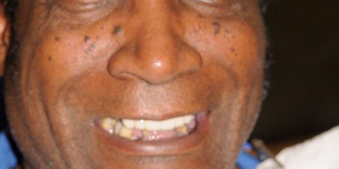 Full Mouth Reconstruction Case 1 - Before