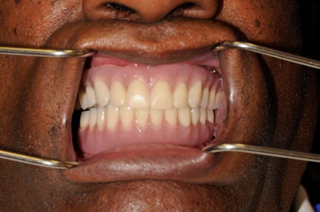 Full Mouth Reconstruction: Case 1 - After