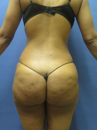 Brazilian Butt Lift Case 6 - Before