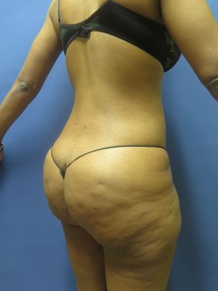 Brazilian Butt Lift: Case 6 - Before