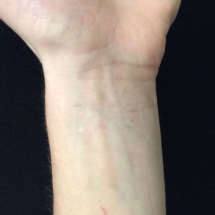 Laser Tattoo Removal Case 6 - After