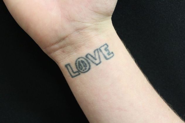 Laser Tattoo Removal: Case 6 - Before