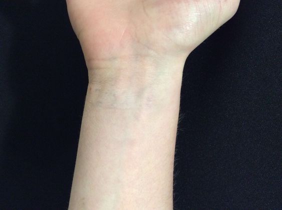 Laser Tattoo Removal: Case 6 - After