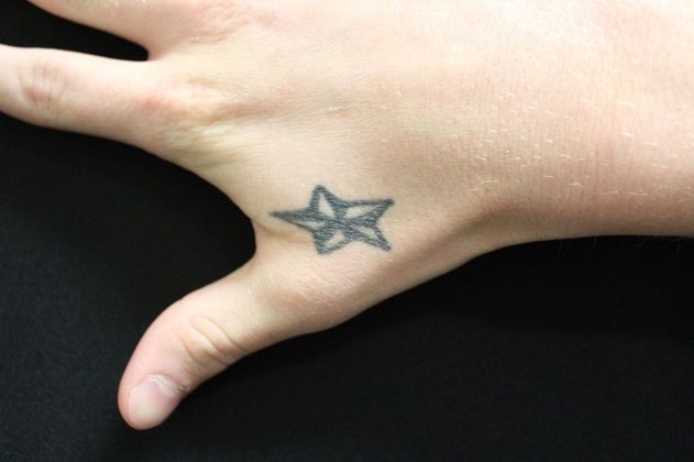 Laser Tattoo Removal: Case 6 - Before