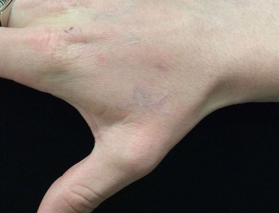 Laser Tattoo Removal: Case 6 - After