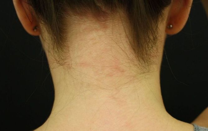 Laser Tattoo Removal Case 7 - After