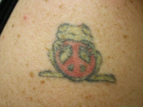 Laser Tattoo Removal Case 8 - Before