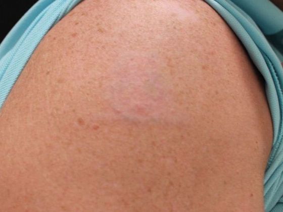 Laser Tattoo Removal Case 8 - After