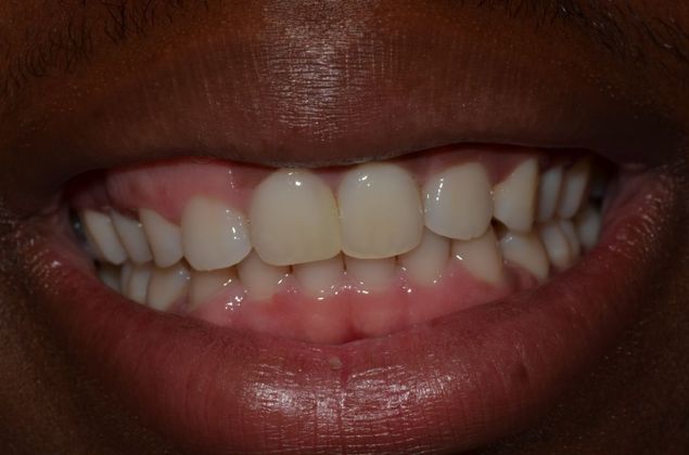 Gum Lift or Crown lengthening Case 1 - Before