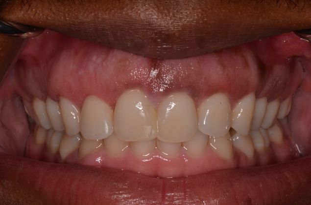 Gum Lift or Crown lengthening: Case 1 - After