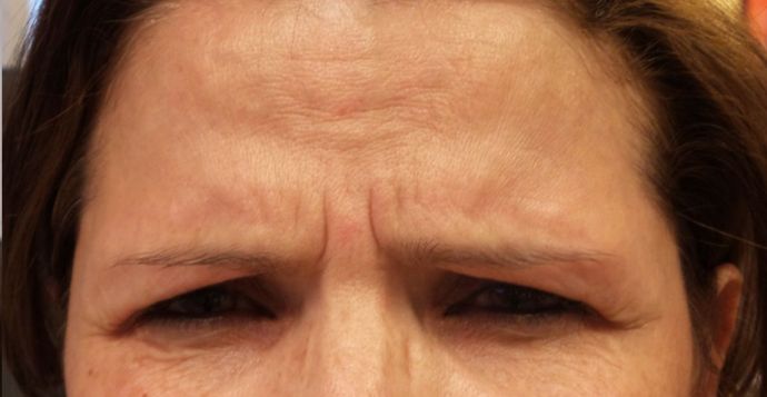 BOTOX® Cosmetic*: Case 6 - Before
