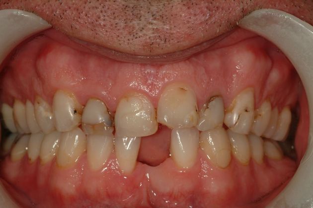 Composite Bonding Case 1 - Before